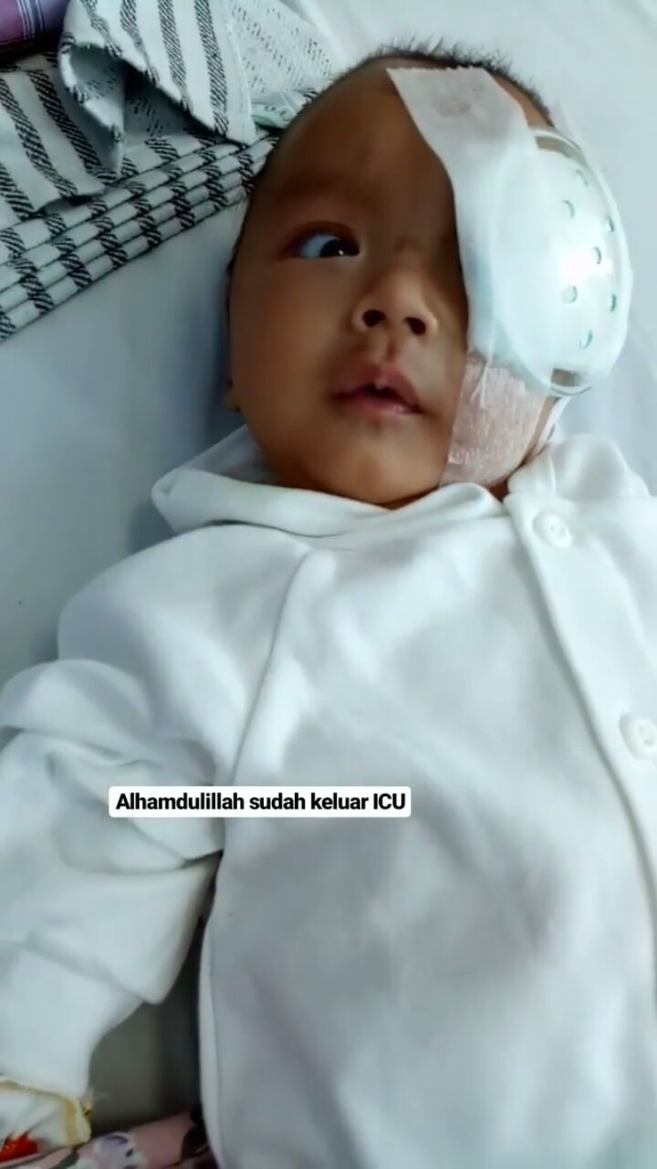 Ini potoku pas operasi mata kiri, aku sempat masuk PICU